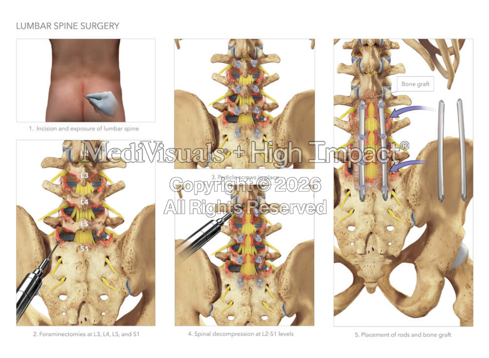 Lumbar Spine Surgery