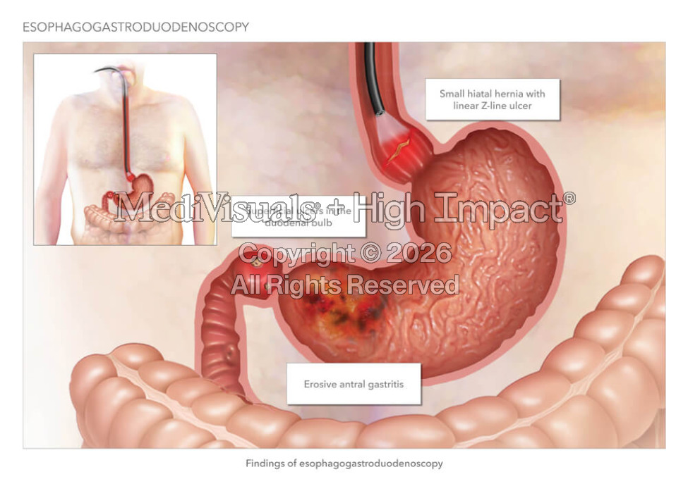 Esophagogastroduodenoscopy