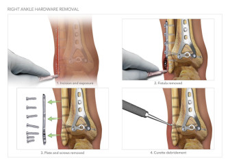 Right Ankle Hardware Removal