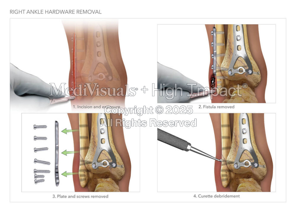 Right Ankle Hardware Removal