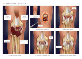 Right Knee Injuries & Fixation