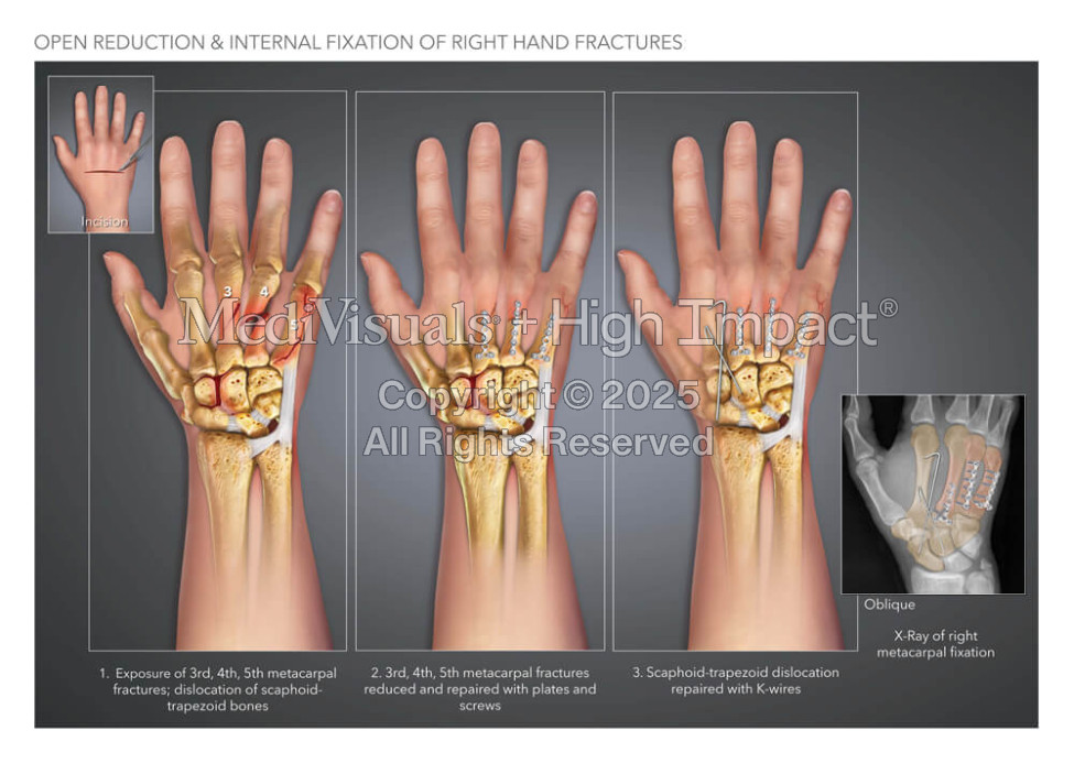 Open Reduction & Internal Fixation of Right Hand Fractures
