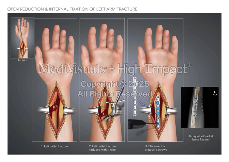 Open Reduction & Internal Fixation of Left Arm Fracture | MediVisuals ...
