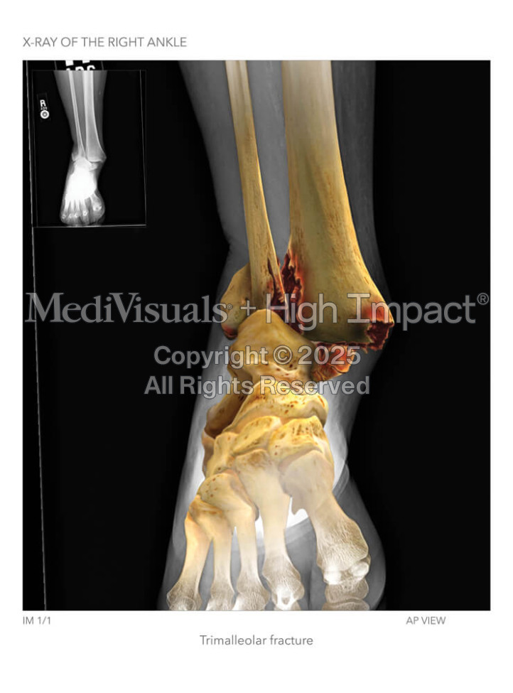 X-Ray of the Right Ankle