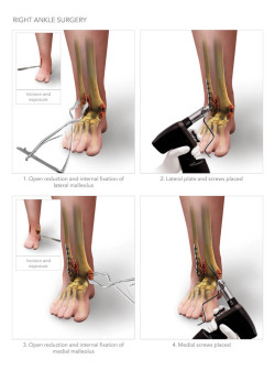 Right Ankle Surgery