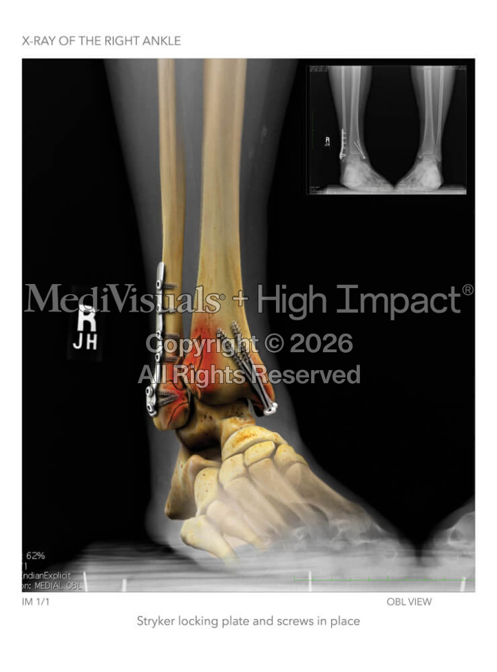 X-Ray of the Right Ankle