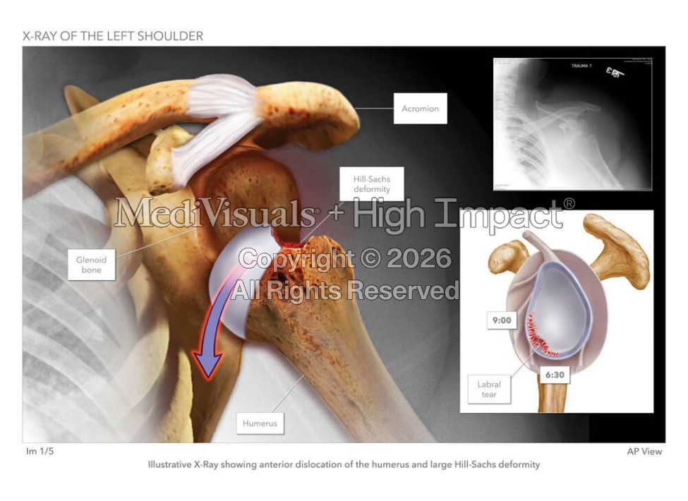 X-Ray of the Left Shoulder