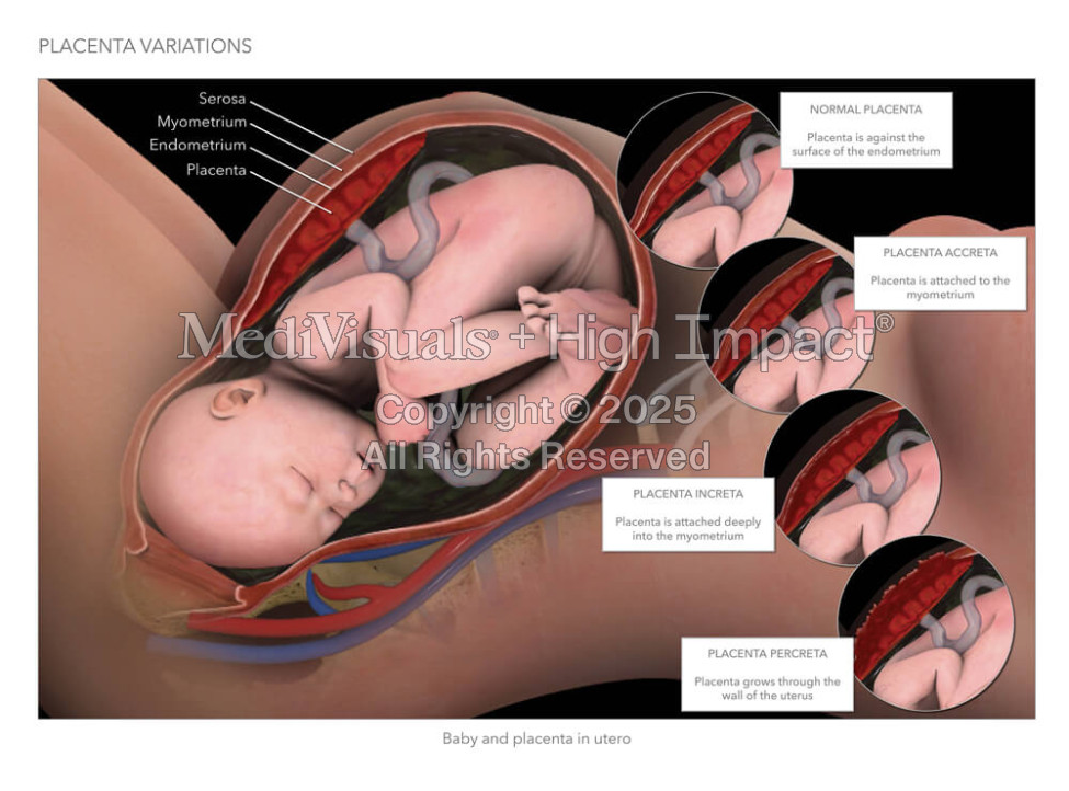 Placenta Variations