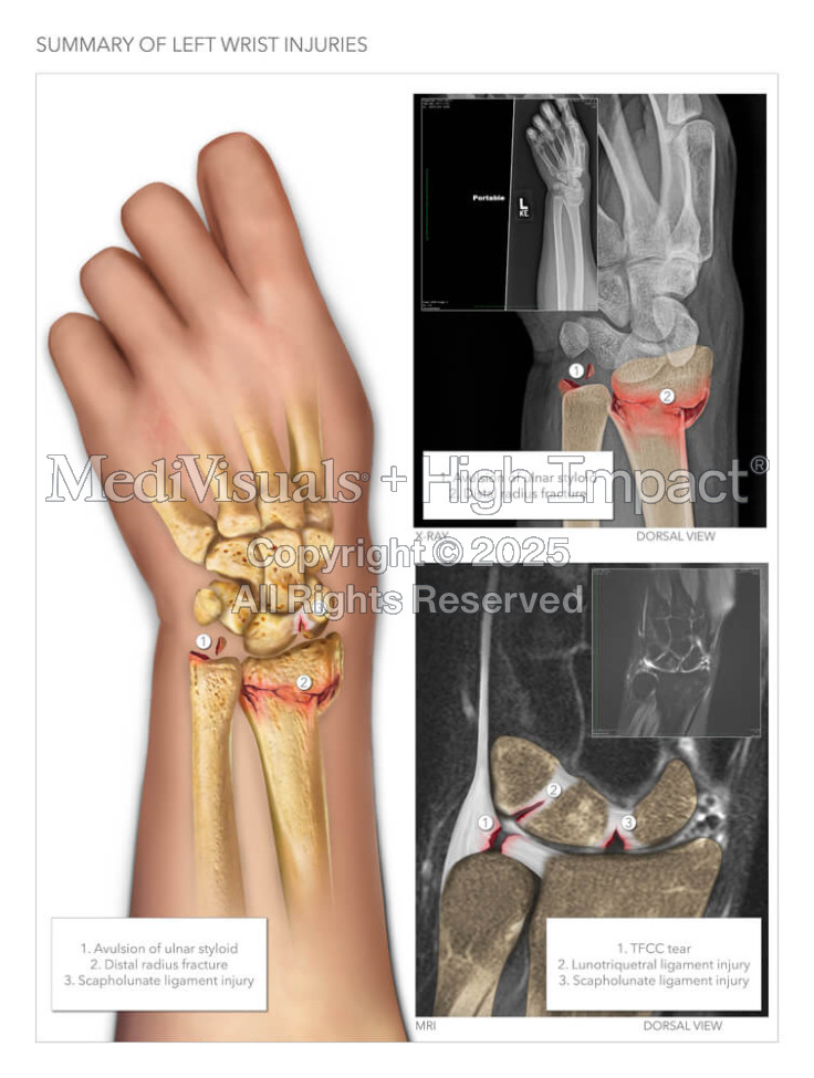 Summary of Left Wrist Injuries