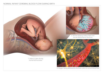 Normal Infant Cerebral Blood Flow During Birth