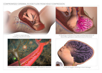 Compromised Cerebral Blood Flow From Head Compression