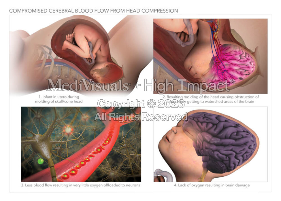 Compromised Cerebral Blood Flow From Head Compression