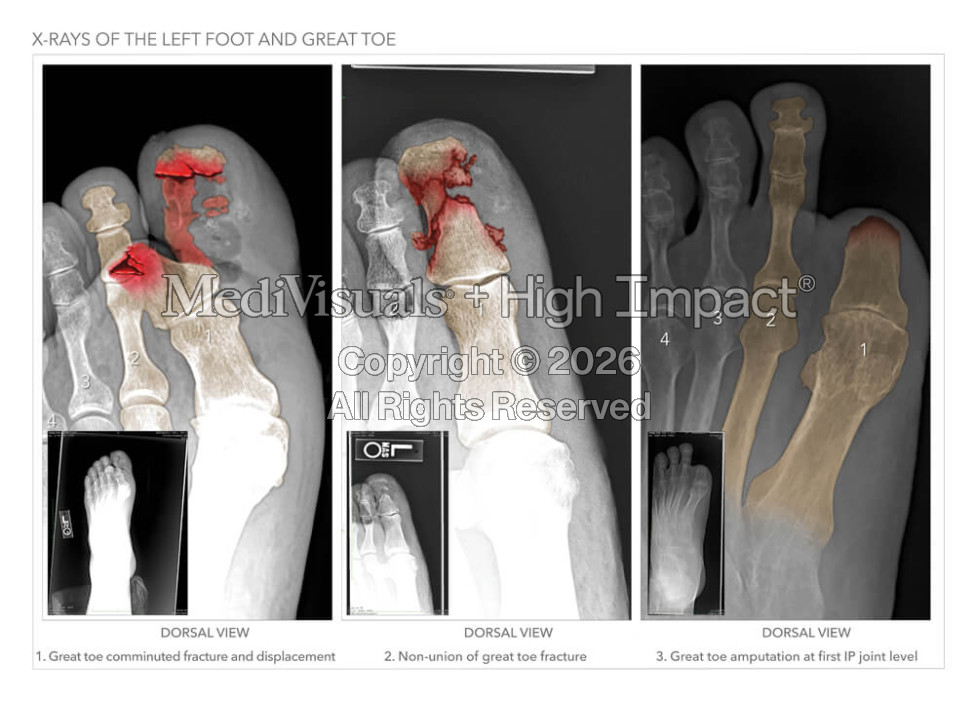 X-Rays of the Left Foot and Great Toe