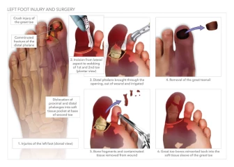 Left Foot Injury and Surgery