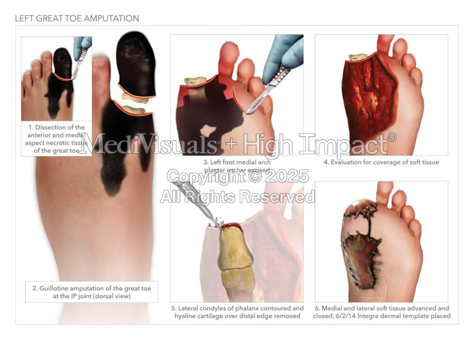 Left Great Toe Amputation