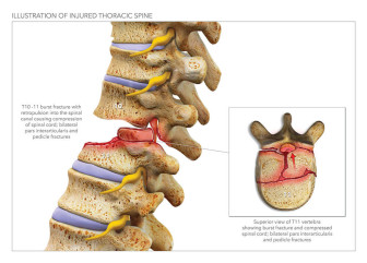 Illustration of Injured Thoracic Spine