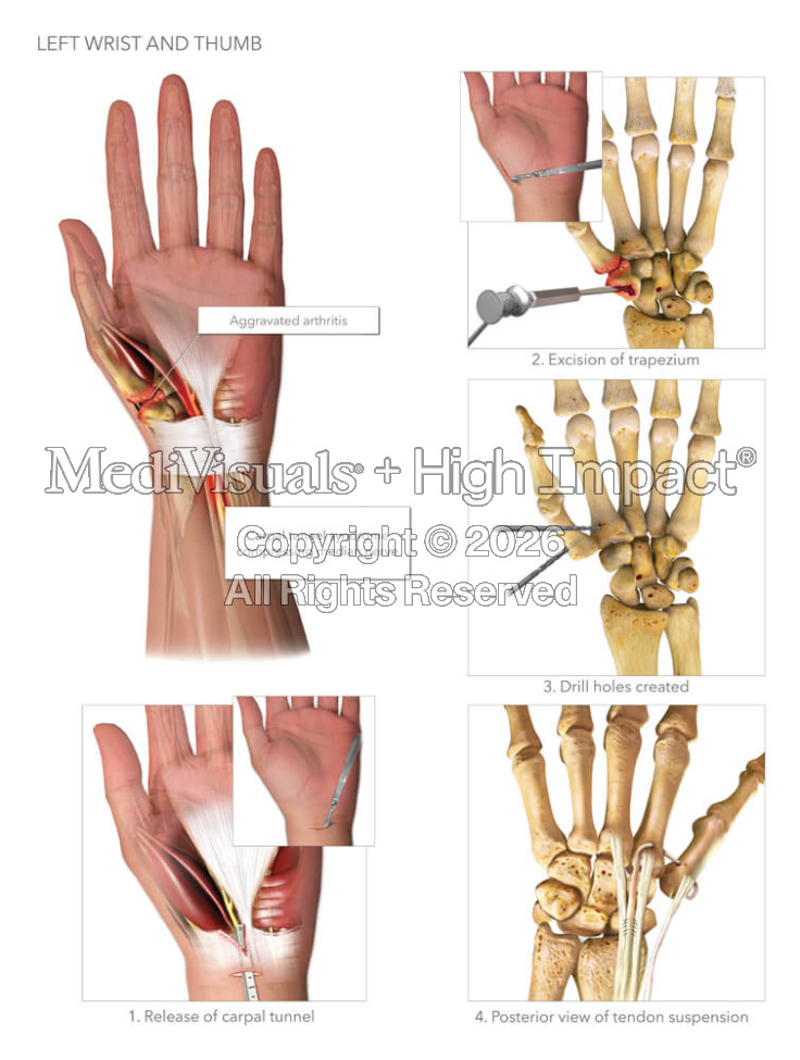 Left Wrist and Thumb
