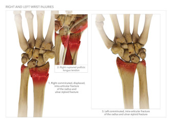 Right and Left Wrist Injuries