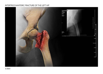 Intertrochanteric Fracture of the Left Hip
