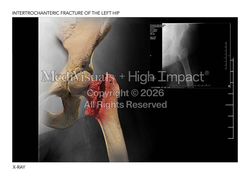 Intertrochanteric Fracture of the Left Hip