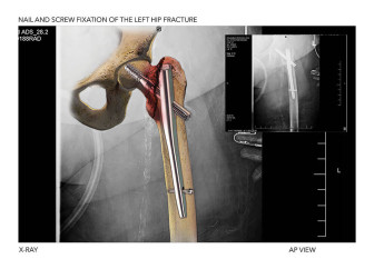 Nail and Screw Fixation of the Left Hip Fracture