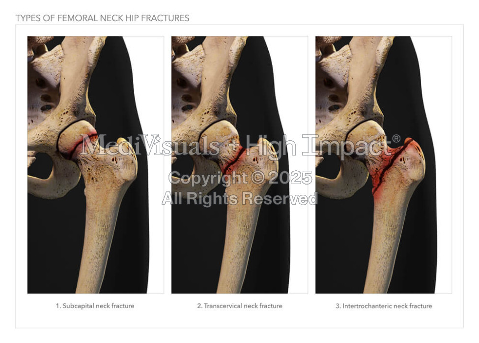 Types of Femoral Neck Hip Fractures