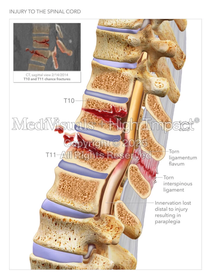 Injury to the Spinal Cord