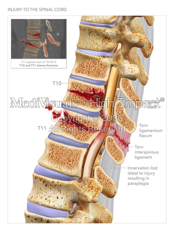 Injury to the Spinal Cord