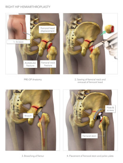 Right Hip Hemiarthroplasty