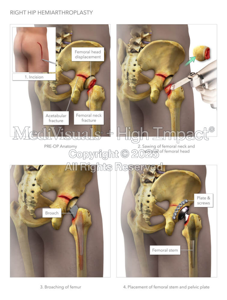 Right Hip Hemiarthroplasty