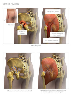 Left Hip Fixation