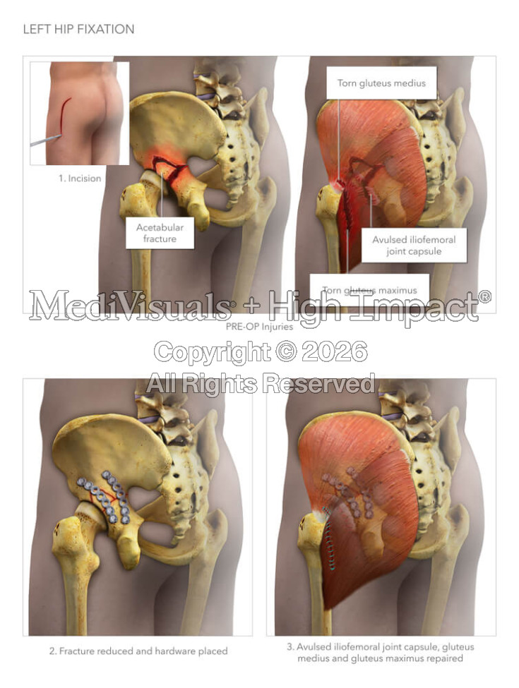 Left Hip Fixation