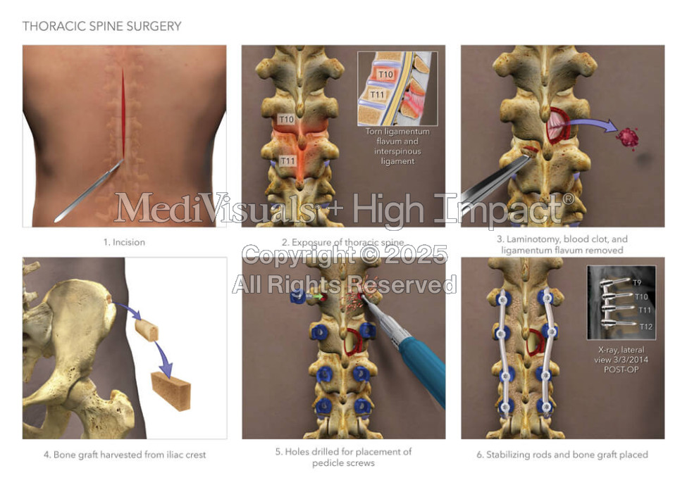 Thoracic Spine Surgery