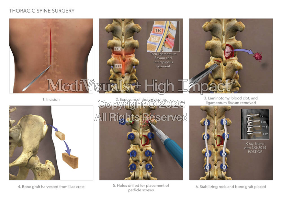 Thoracic Spine Surgery