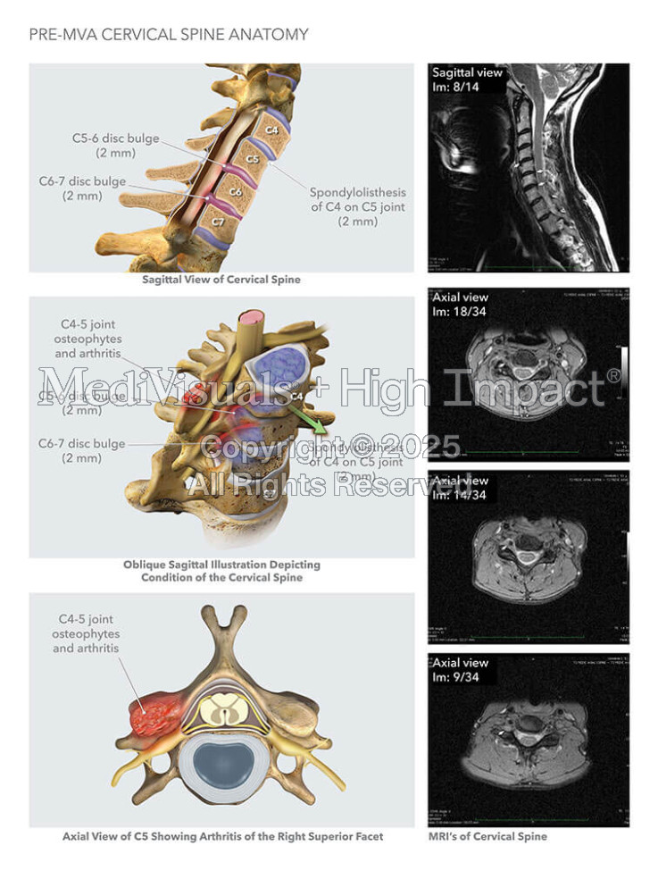 Pre-MVA Cervical Spine Anatomy