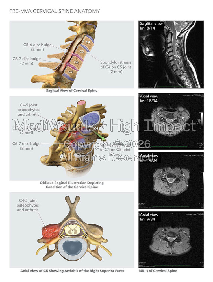 Pre-MVA Cervical Spine Anatomy