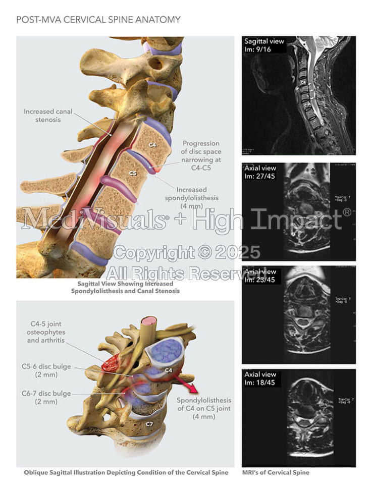 Post-MVA Cervical Spine Anatomy