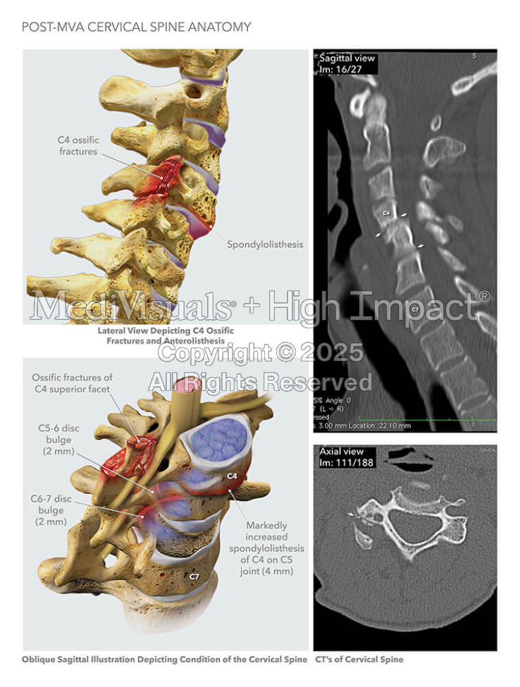 Post-MVA Cervical Spine Anatomy