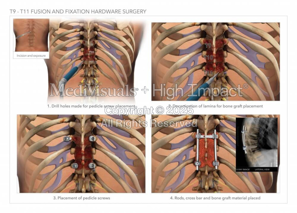 T9-T11 Fusion and Fixation Hardware Surgery