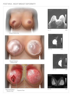 Post MVA - Right Breast Deformity