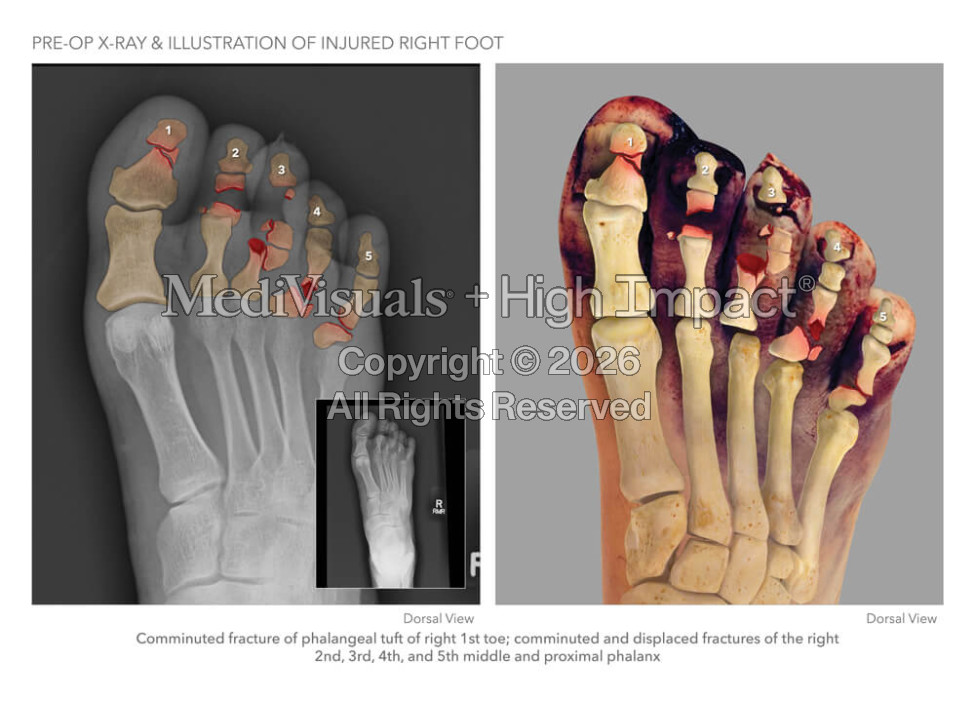 Pre-Op X-Ray & Illustration of Injured Right Foot