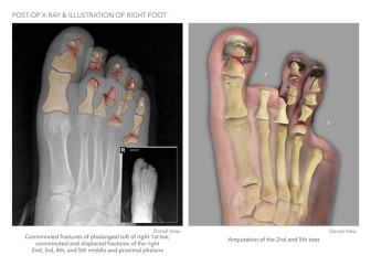 Post-Op X-Ray & Illustration of Right Foot