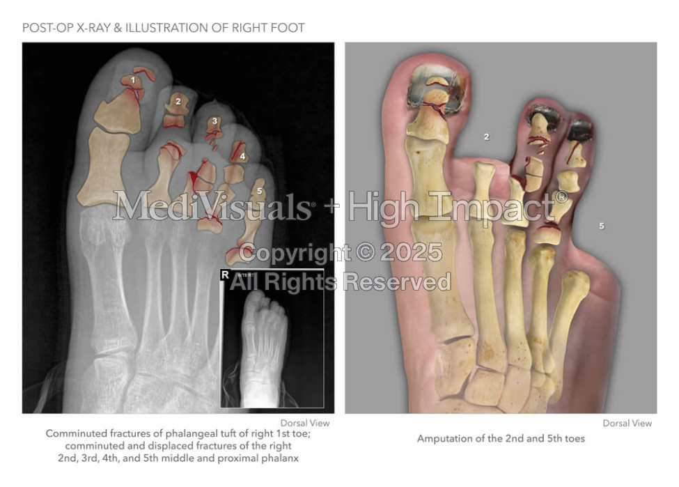 Post-Op X-Ray & Illustration of Right Foot