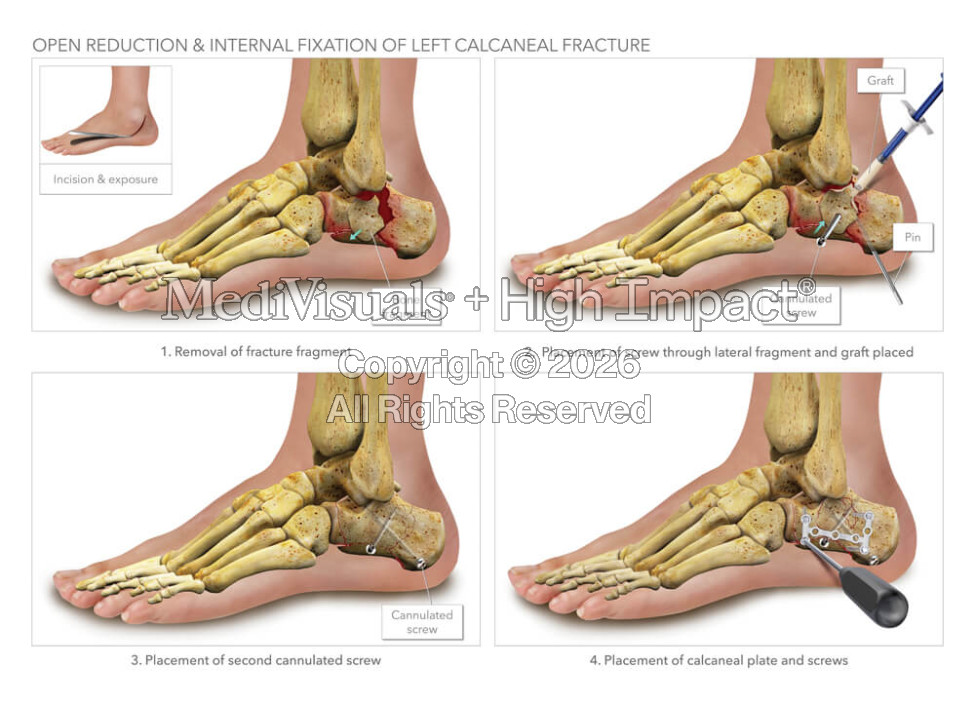Open Reduction & Internal Fixation of Left Calcaneal Fracture