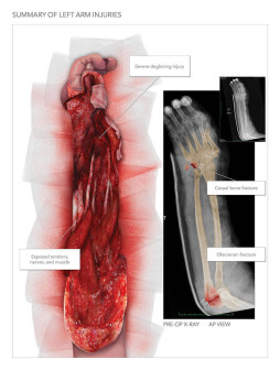 Summary of Left Arm Injuries