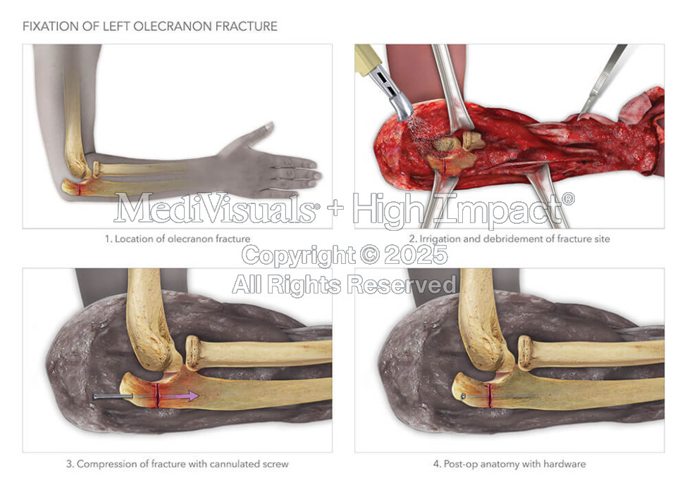 Fixation of Left Olecranion Fracture