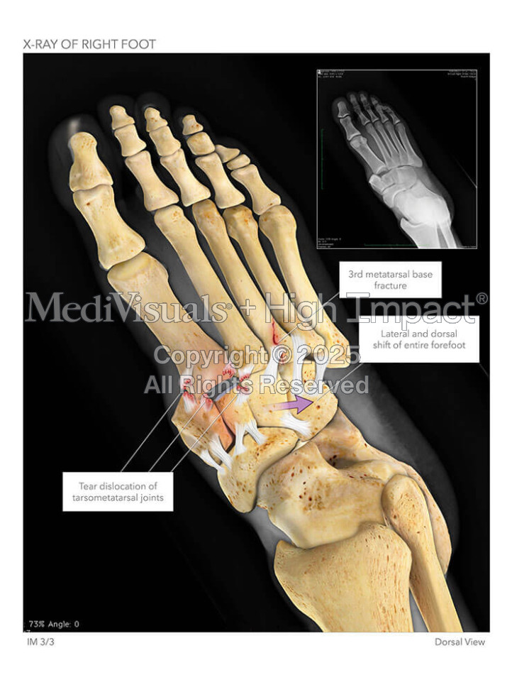 X-Ray of Right Foot