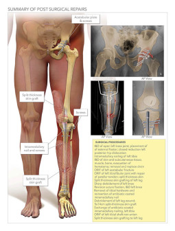Summary of Post Surgical Repairs