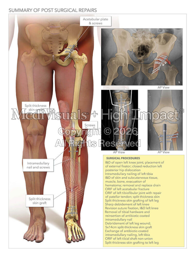 Summary of Post Surgical Repairs