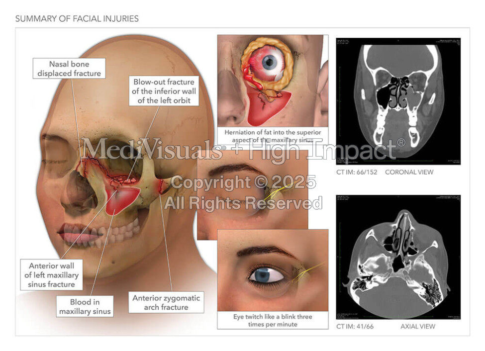 Summary of Facial Injuries